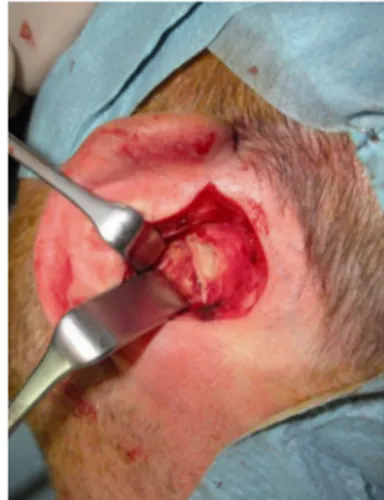 FIGURE 6. Incision of the anterior wall of the canal and consequently the entire external auditory canal transected.