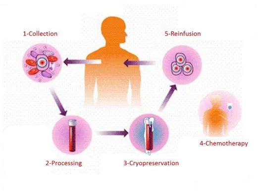 Figure 2: The autologous transplant process. 1-Collection: stem cells are collected from the patient’s bone marrow 