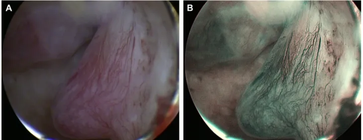 Fig. 1. Images of conventional (A) and narrow-band imaging (B) hysteroscopy because of endometrial hyperplasia.