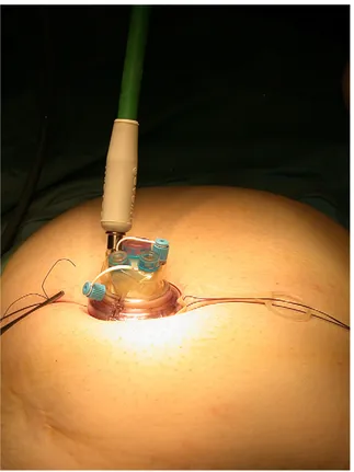 Fig. 1. TriPort device (Olympus America Inc.) in situ with insufflation line attached.