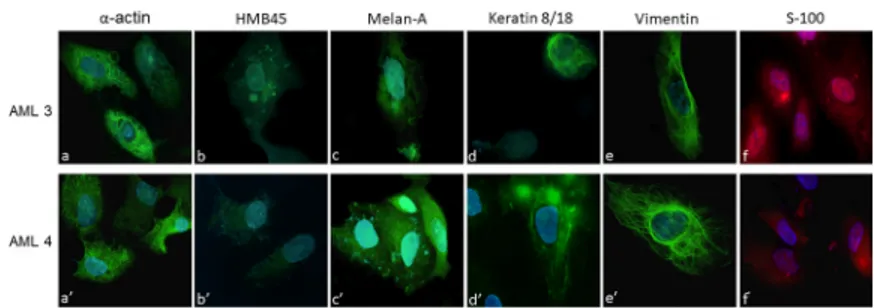 Fig 1. Primary angiomyolipoma cells characterization by immunofluorescence. Cells isolated from the two