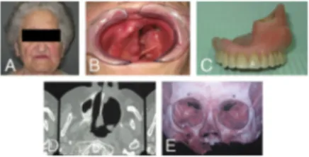 FIGURE 2. Intraoperative sequence (A, B) and postoperative healing (C) of the pedicled temporalis muscle flap.