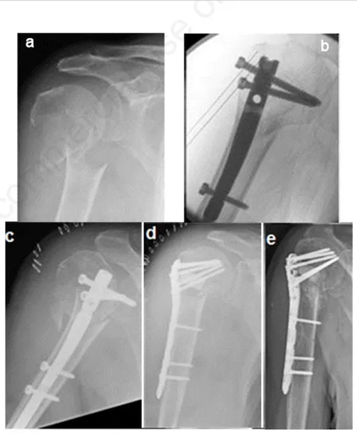 Figure  2.  Right  proximal  humeral  2-part  fracture  in  a  76-year-old  woman  affected  by moderate  dementia:  (a)  preoperative  x-rays;  (b)  intraoperative  fluoroscopy  showing  a wrong  entry  point  (too  anterior  and  lateral)  and  an  exces