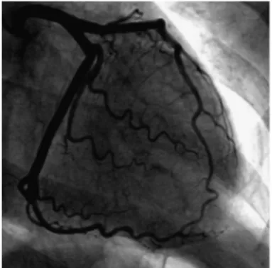 FIGURE 2. A and B, A 12-lead ECG showing evolution of widespread ST/T wave changes throughout the anterior cheat leads without Q waves including dynamic ST elevation (A) and T wave inversion (B).