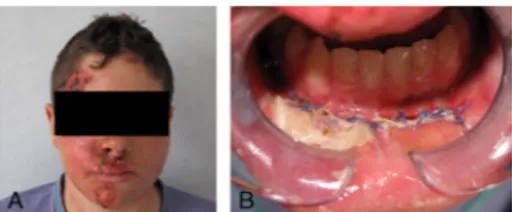 FIGURE 3. Photographs showing the clinical view (A) and the endoral wound (B).