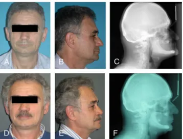 FIGURE 2. Male patient’s preoperative and postoperative frontal views (A, D), profiles (B, E), and preoperative (F) and postoperative (C) teleradiographic images.