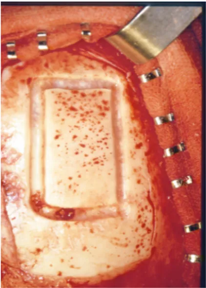 FIGURE 3. Correlation between postoperative diplopia and time of surgery.