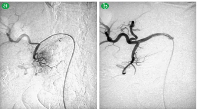 Figure 3. Angiogram of gastroduodenal artery. (a). In the late arterial phase the insulinoma appears as hypervasculated mass