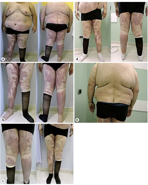 Fig. 1.  Patient No. 1, at presentation (a, b), after 1 month (c), and 4 months (d, e) of secukinumab treatment