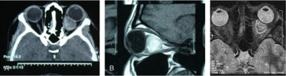 FIGURE 2. AYC, Computed tomography and MRI scans showing left retrobulbar intraconal hematoma.