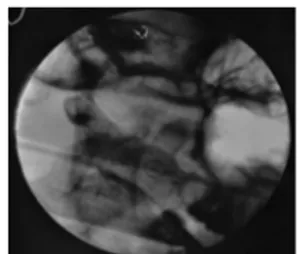 FIGURE 1. Needle broken in the pterygomandibular area; fluoroscopic intraoperative radiograph.