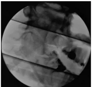 FIGURE 2. Fluoroscopic intraoperative radiograph after the foreign body removal.