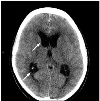 Fig. 1. CT scan showed subarachnoid hemorrhage, blood in the lateral ventricles, and ventricular dilation.