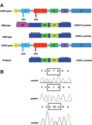 Fig. 1. GATA-1 mutation; (A) Schematic representation of GATA-1 protein production, Description of normal and alternative translation initiation sites located at methionine 1 and 84, respectively
