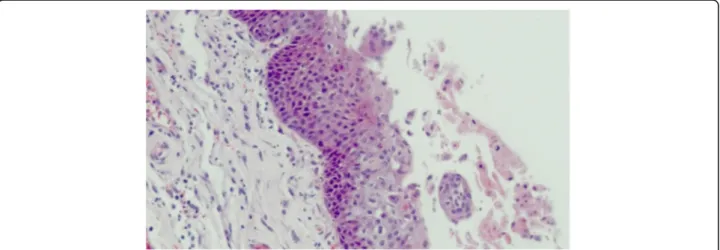 Fig. 1 Histological findings at autopsy. Pharyngeal mucosa showing acantholytic keratinocytes with intranuclear inclusions (hematoxylin-eosin staining, magnification × 200)
