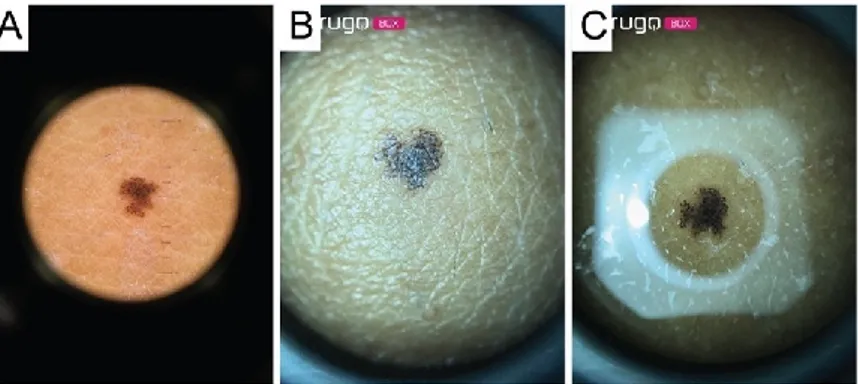 Figure 5. Image of a melanocytic nevus acquired through: (A) contact dermatoscope; (B) Nurugo 