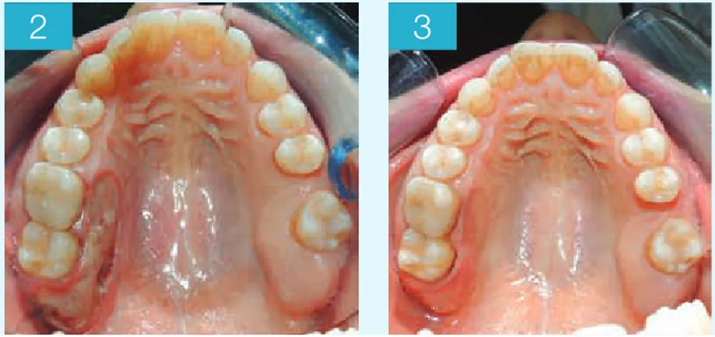 Fig. 2  Buona guarigione post-operatoria 