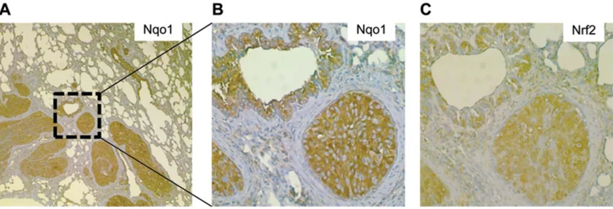 Fig. 4. The Nrf2/Keap1 pathway is activated in lung metastases. (A) Representative photomicrograph of a lung displaying several HCC metas- metas-tases, immunostained for Nqo1 (310)