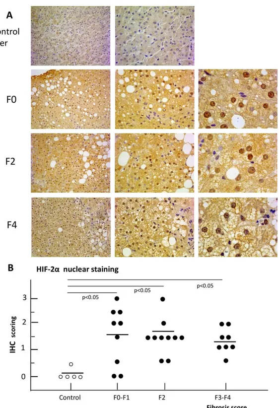 FIG. 1. Expression of HIF-2a in human liver disease. IHC analysis of HIF-2a in parafﬁn-embedded human liver specimens from NAFLD patients (n 5 27) with different degrees of liver ﬁbrosis (F0-F4) (A)