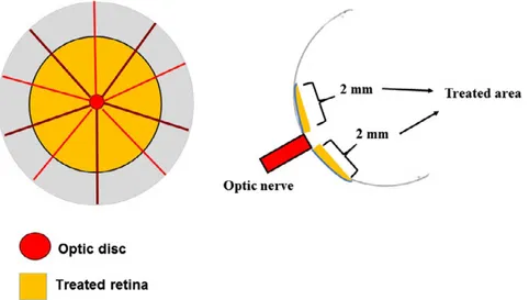 Fig. 1. Schematic representation of the eye fundus treated by laser.