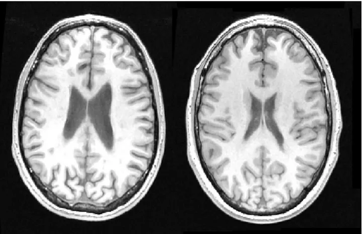 Figure 1: left: T1 weighted axial brain slice of a 36 year old male with RRMS and a disease  duration of 12 years