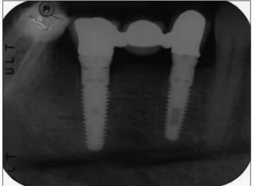 Figure 1: Intra-oral Rx showing implant with abutments Figure 2: The 12-month post-loading control