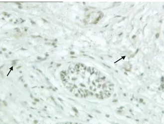 Fig. 1. PA: Focal CD10 positivity of the stromal cells, indi- indi-cated by black arrows (CD10, ⫻200).