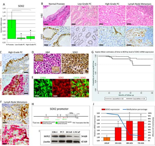 Figure 1: Expression of SOX2 in normal and neoplastic prostate tissue from PC patients
