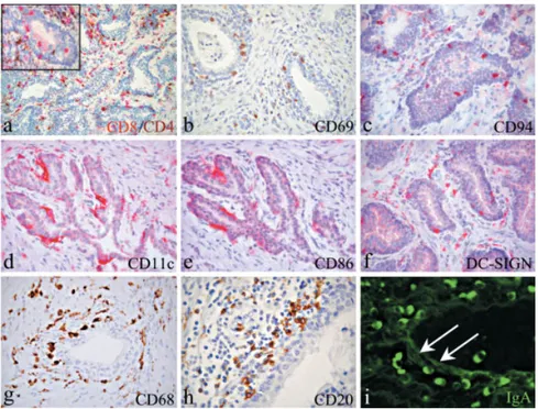 Fig. 2. Immunohistochemical characterization of leukocyte populations infiltrating the prostatic glandular epithelium