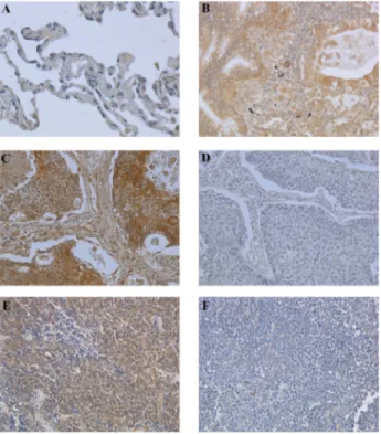 Figure 1: Immunohistochemical analysis of BAG3  expression in normal and neoplastic lung samples