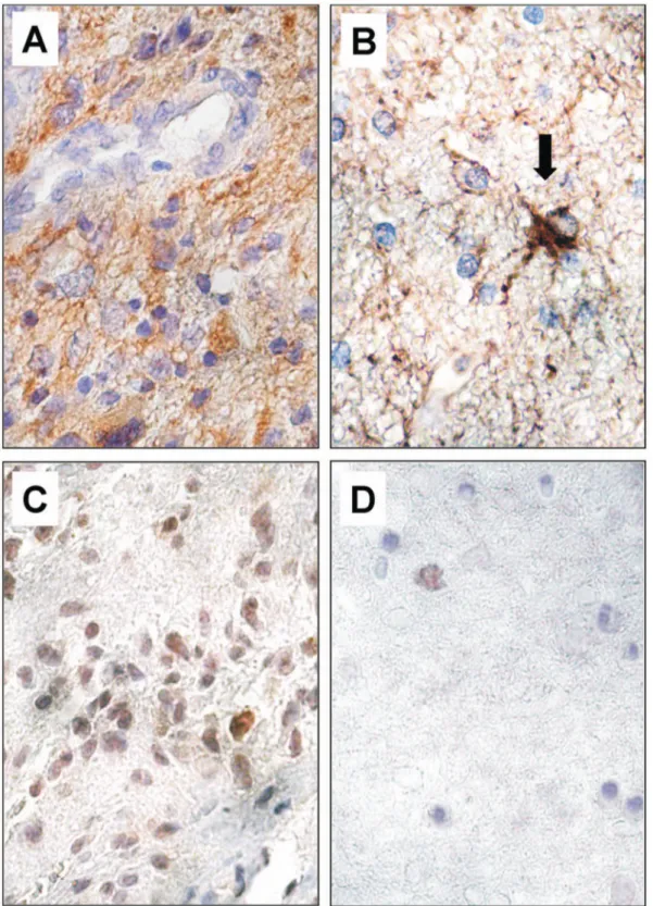 Figure 5. Immunohistochemical staining for GFAP and TAZ in ET and BAT. The majority of GBM cells showed intense diffuse cytoplasmic staining for GFAP (A)