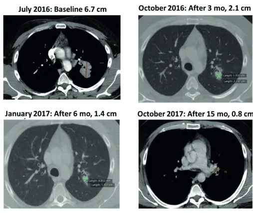 Figure 5. Tumor size progressive reduction during nivolumab treatment.