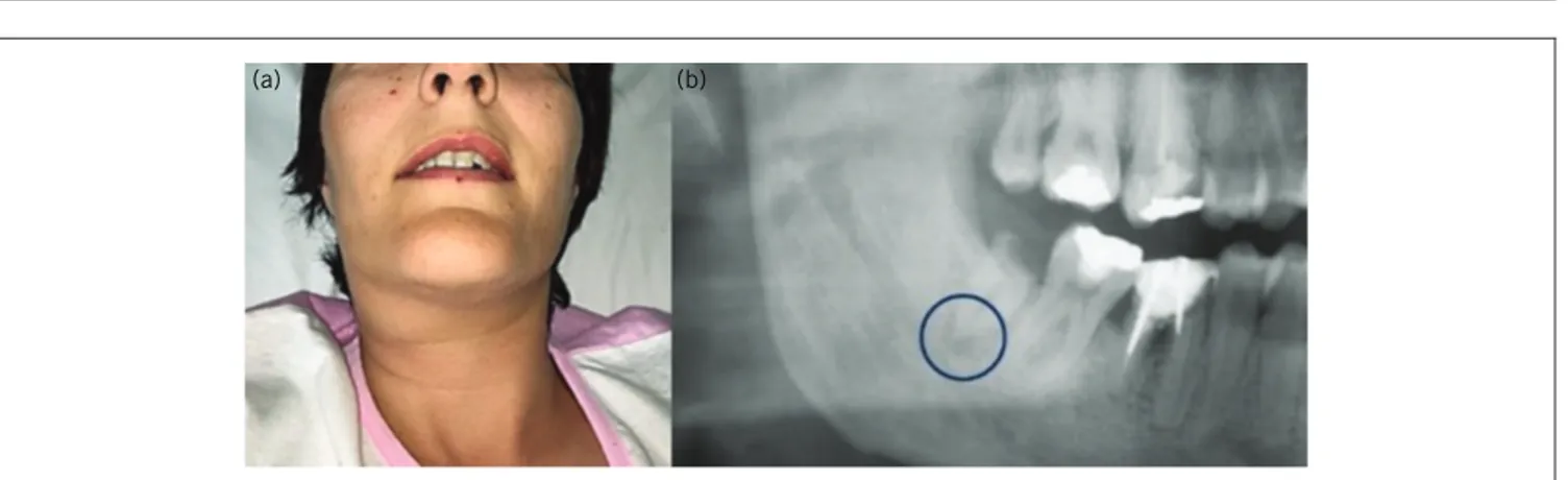 Figure 1 Extra oral (A) clinical presentation of the patient at admission. (B) Pretreatment panoral radiograph showing the causative tooth.