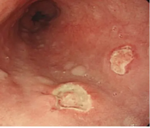 Figure 3  Drug-induced esophageal damage. Endoscopic view of a patient 