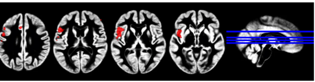 Figure 3. Regions of reduced cerebral blood flow in the hydrocortisone versus placebo  condition during trauma script presentation in all participants (PTSD and TEC groups,  cluster-wise FDR&lt;0.001; n=22) 