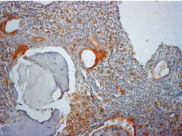 Figure 6 Marrow spaces show CD31+ microvessels (*), located predominantly in the connective tissue