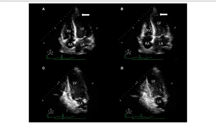 FIGURE 2 | Transthoracic echocardiography of a 32-year-old woman with acute dyspnea 1 day after delivery