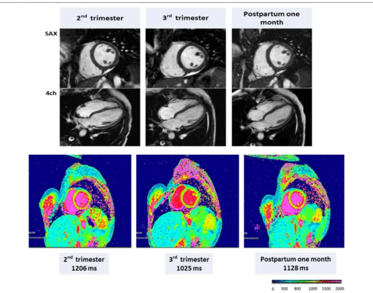 FIGURE 4 | CMR in a representative pregnant woman with end-diastolic volume (EDV), end-systolic volume (ESV), ejection fraction (EF), and left ventricular mass (LVM), respectively, of 132 mL, 69 mL, 48.0%, and 106 g during the second trimester; 136 mL, 60 
