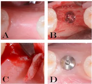 Figure 2. Explanatory images of the treatment performed (A–D). (A) residual crest. (B) gel inserted 