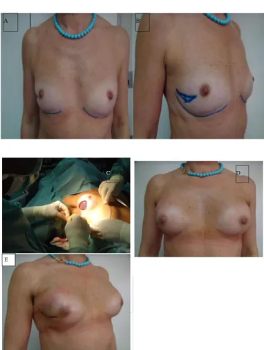 Figure 1: [A]: Traditional incision, retraction forces shown by the flashes.  [B]: The new technique.