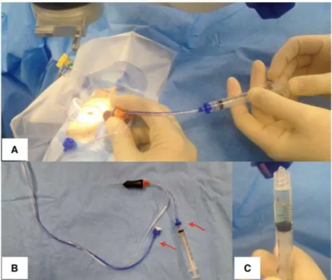 Figure 5. Obtaining a vitreous sample with vitrectomy. (A) The assistant is manually aspirating via a syringe while the surgeon is cutting with the vitrector