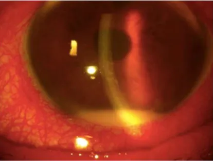 Figure 1. Hypopyon in a patient with infective uveitis. An anterior segment photograph of an eye of a 70-year-old male with hypopyon secondary to bacterial endophthalmitis.