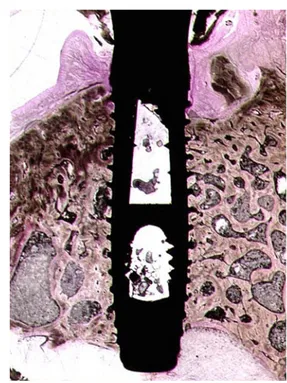 Fig. 7 Low-power view of a histologic slide of an implant rehabilitated with a metal restoration