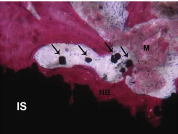 Fig. 2   The newly formed bone (NB) grows inside the implant surface  (IS) irregularities