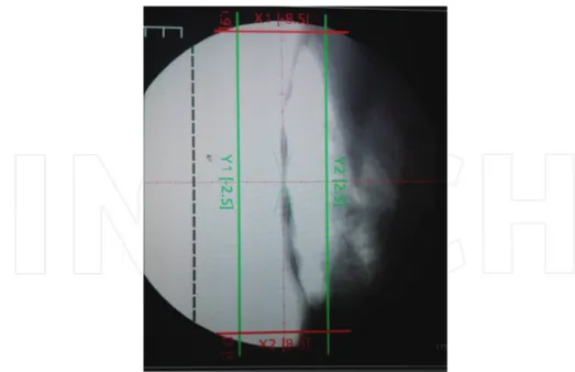 Figure 6. Simulator planning image for a chest wall radiation field at the NCI‐UG.