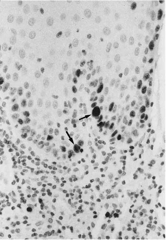 FIGURE 2. Severe dysplasia, showing strong positivity to p53 is seen in