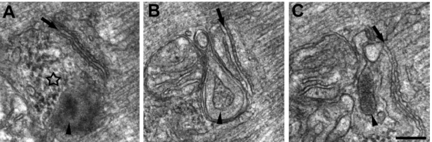 FIGURE 4. Accumulation of amorphous electron-dense material and formation of membrane-bound granular inclusions in proximity of triads and