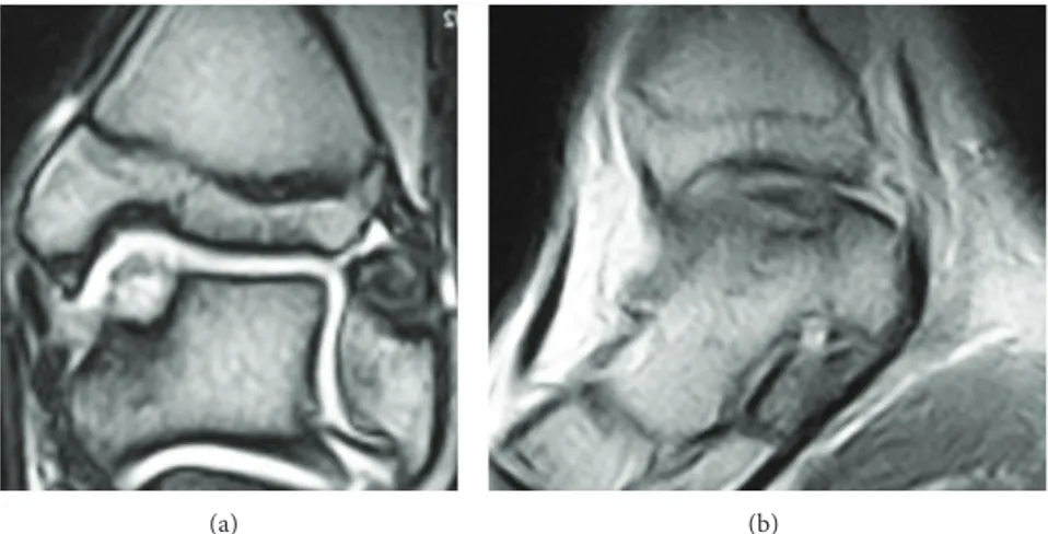 Figure 1: Preoperative coronal (a) and sagittal (b) MRI views before the first operation, showing a IIA type lesion, according to Giannini’s classification.