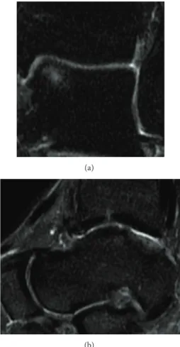 Figure 2: Coronal MRI view 2 years after the first operation. The cartilaginous layer was present, but it was submined by a subchondral cyst.