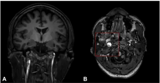 Fig. 1. Magnetic Resonance Imaging (MRI) and Magnetic Resonance Angiography (MRA)of the brain performed after SE recovery